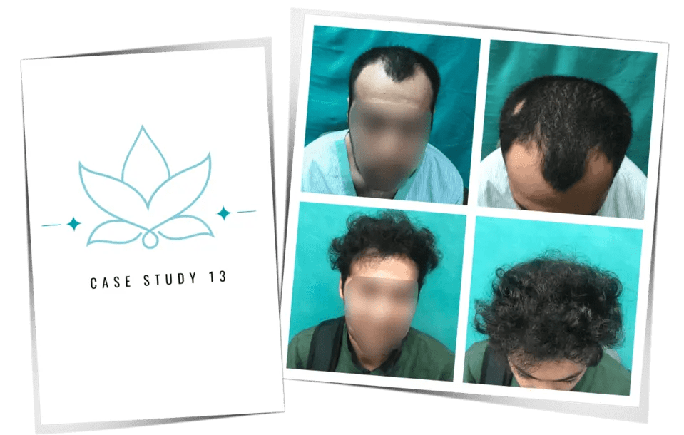 Hair Transplant