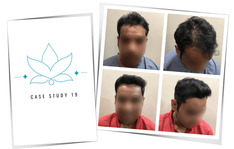 Hair Transplant