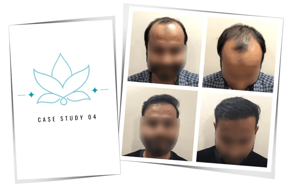 Hair Transplant